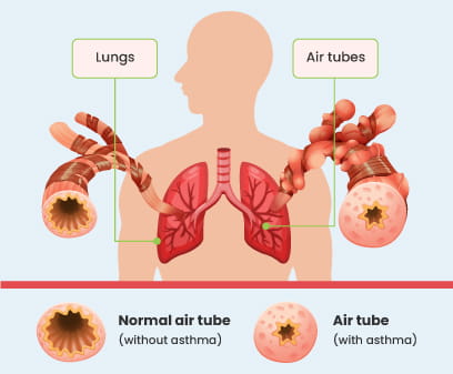 Asthma